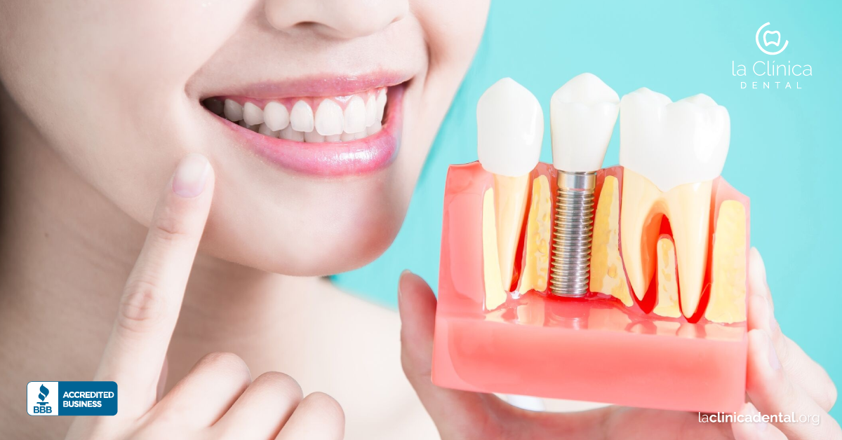 ventajas y desventajas de los implantes dentales