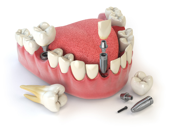 Promociones en implantes dentales